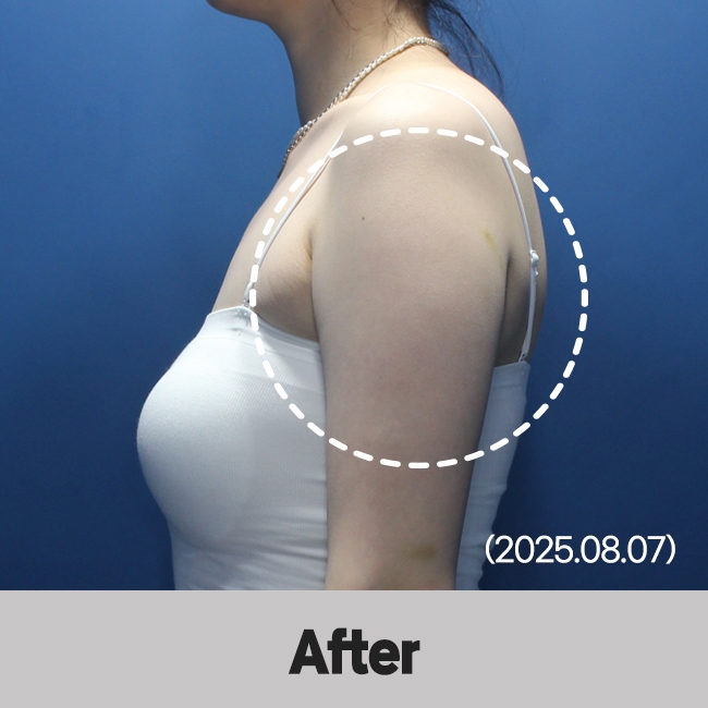 다이어트약+쉬다주사(Body) 시술 후